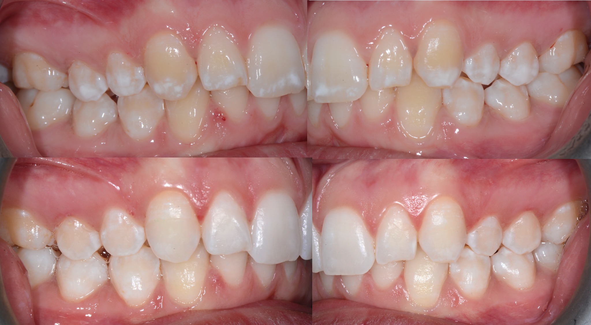 Vues latérales Baseline vs Post-treatment — Fluorose TF2 — Dr Aldo Mazzella