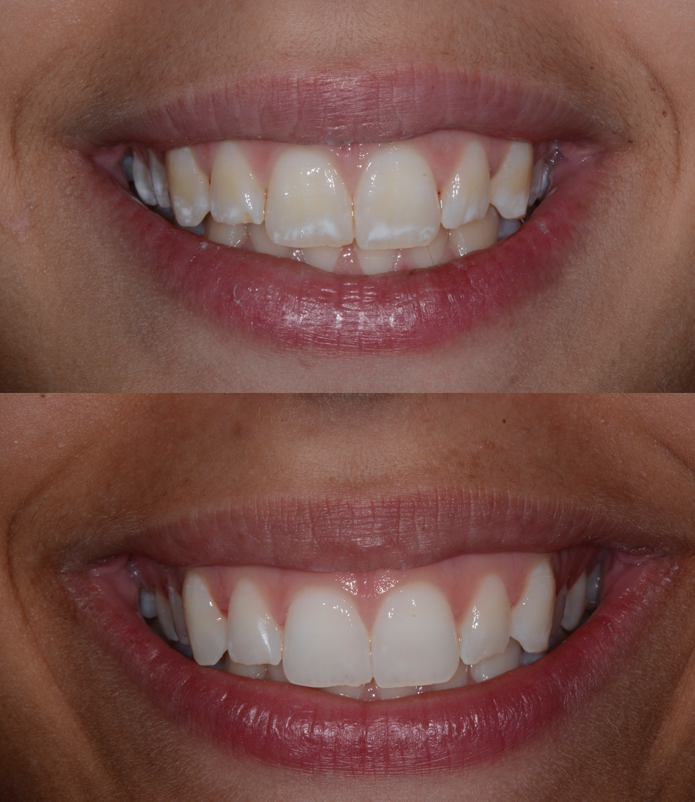 Sourire Baseline vs Post-treatment — Fluorose TF2 — Patiente 19 ans — Dr Aldo Mazzella