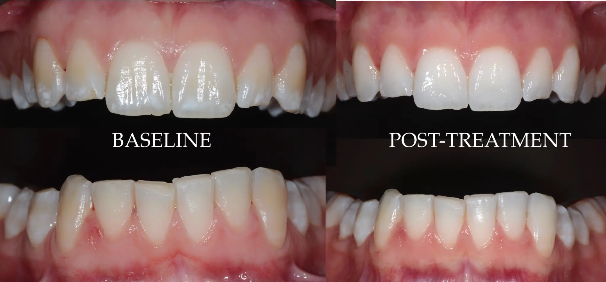 Vue frontale arcades sup & inf — Baseline vs Post-treatment — Fluorose TF2 — Dr Aldo Mazzella