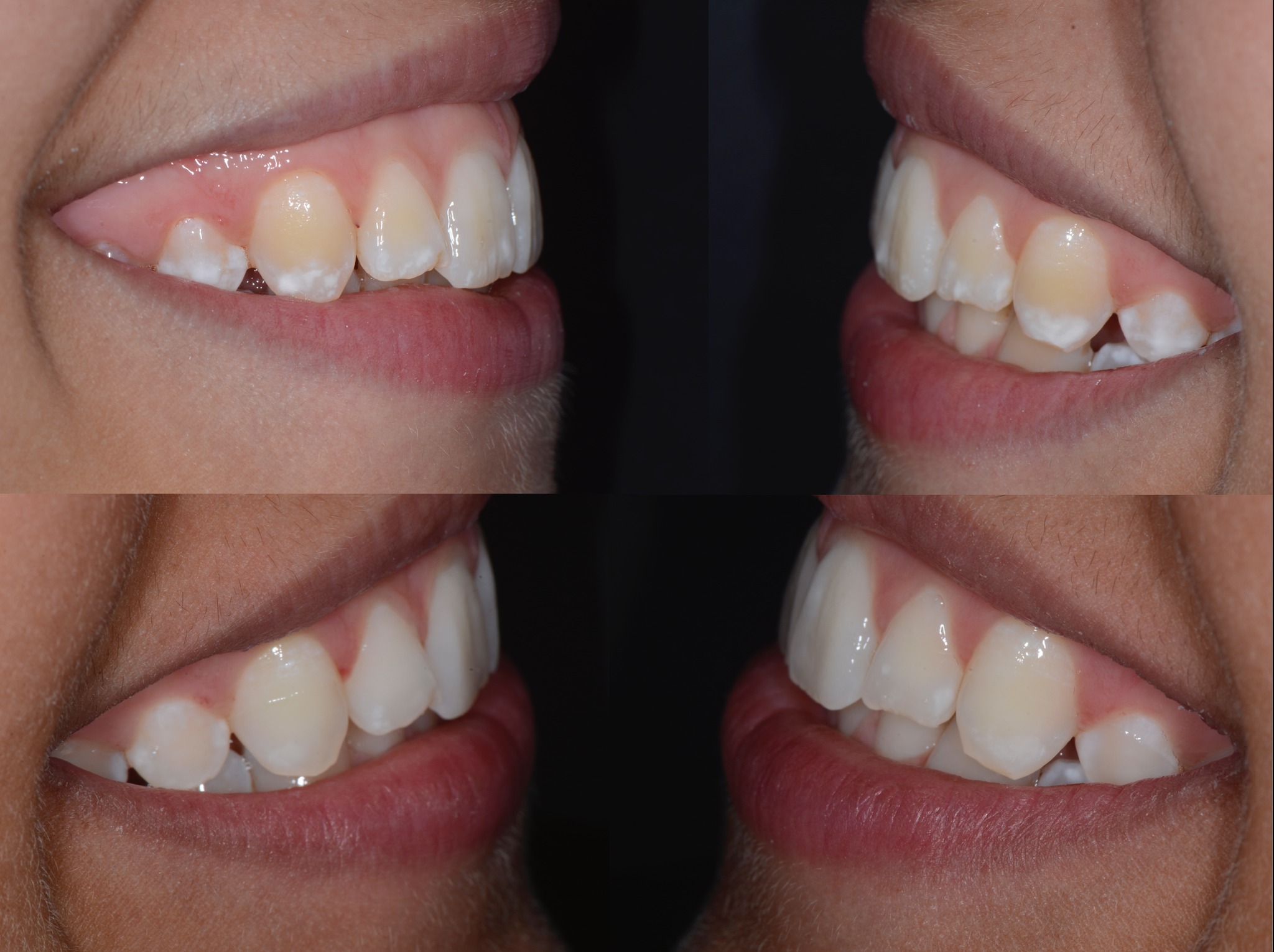 Vues latérales droite/gauche — Fluorose TF2 — Dr Aldo Mazzella