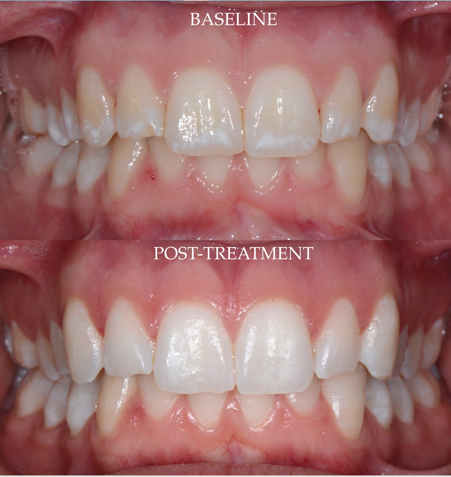 Vue frontale intrabuccale Baseline vs Post-treatment — Fluorose TF2 — Dr Aldo Mazzella