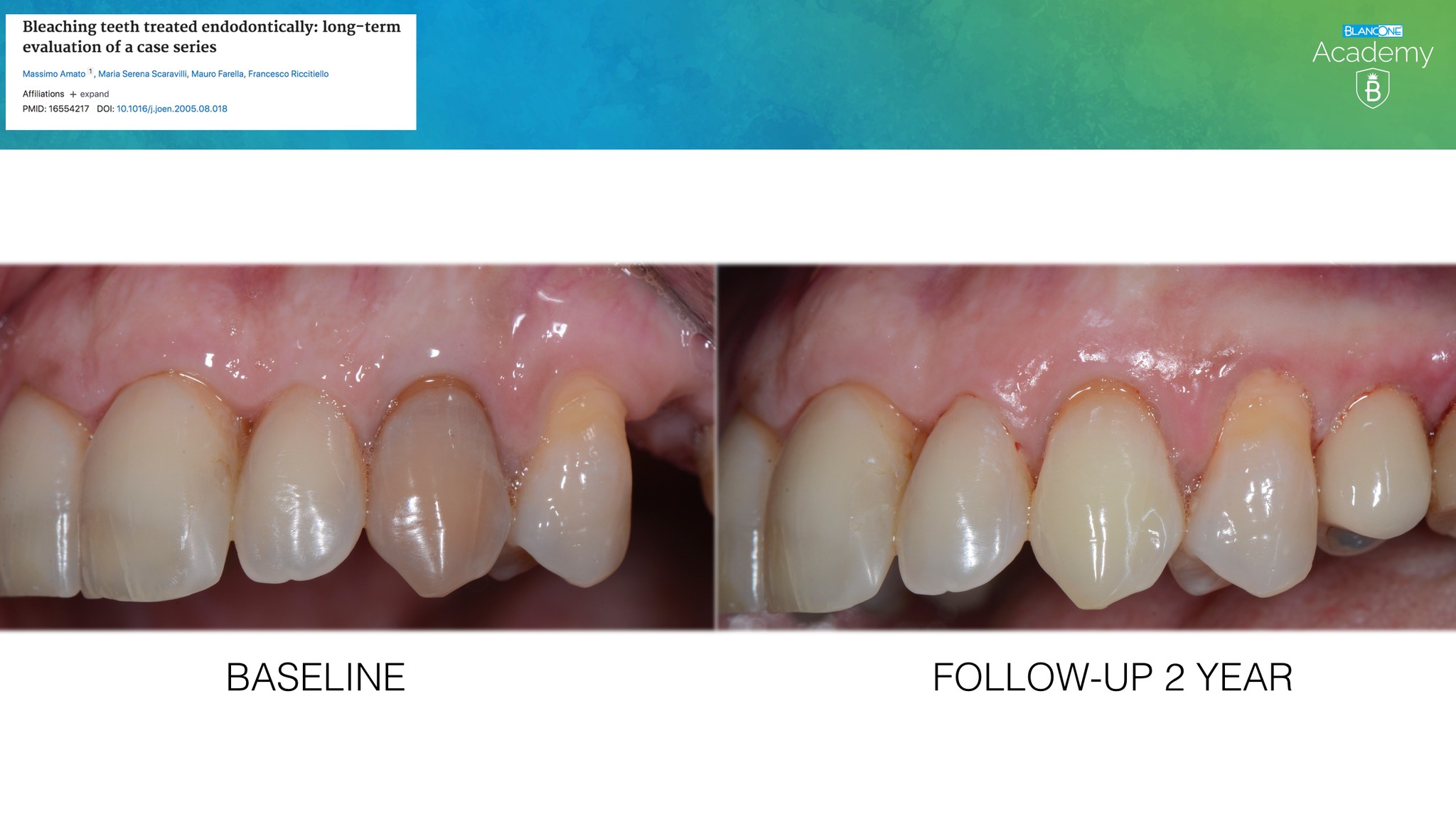 Baseline vs Follow-up 2 ans — Dent 23 dépulpée — Éclaircissement interne hybride — Dr Aldo Mazzella
