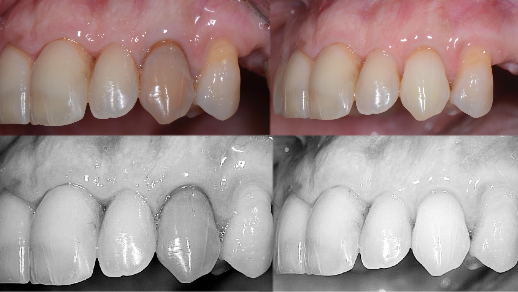 Comparaison chromatique en noir & blanc — Baseline vs Follow-up 2 ans — Dent 23 — Dr Aldo Mazzella