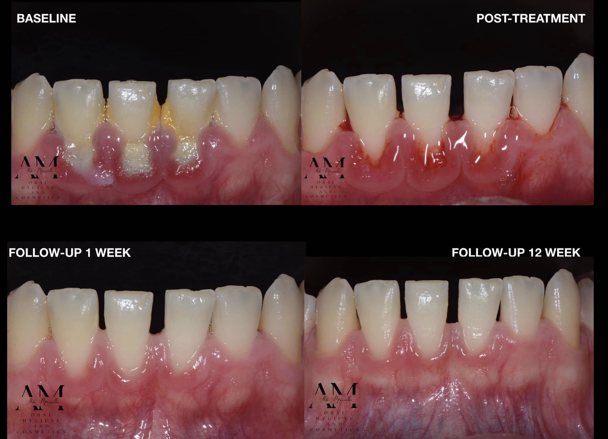 Baseline / Post-treatment / Follow-up 1 semaine / Follow-up 12 semaines — Dr Aldo Mazzella