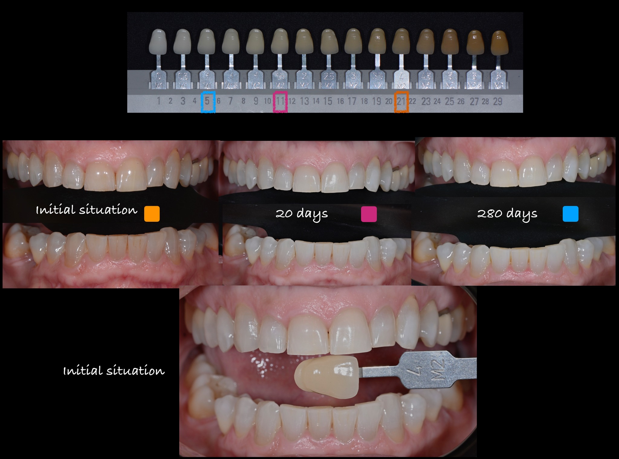 Teintier VITA — progression J0 (21) → J280 (5)