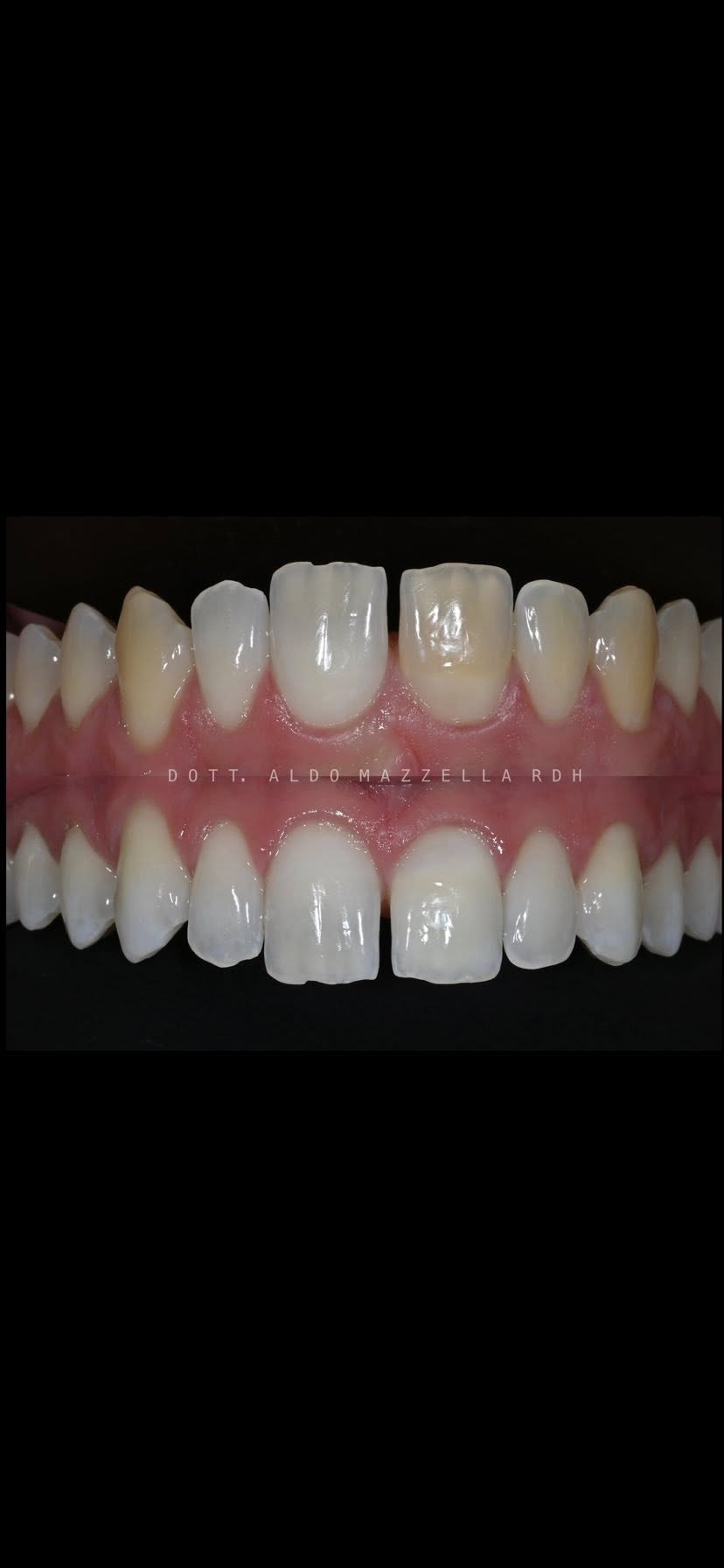 Vue occlusale — situation initiale