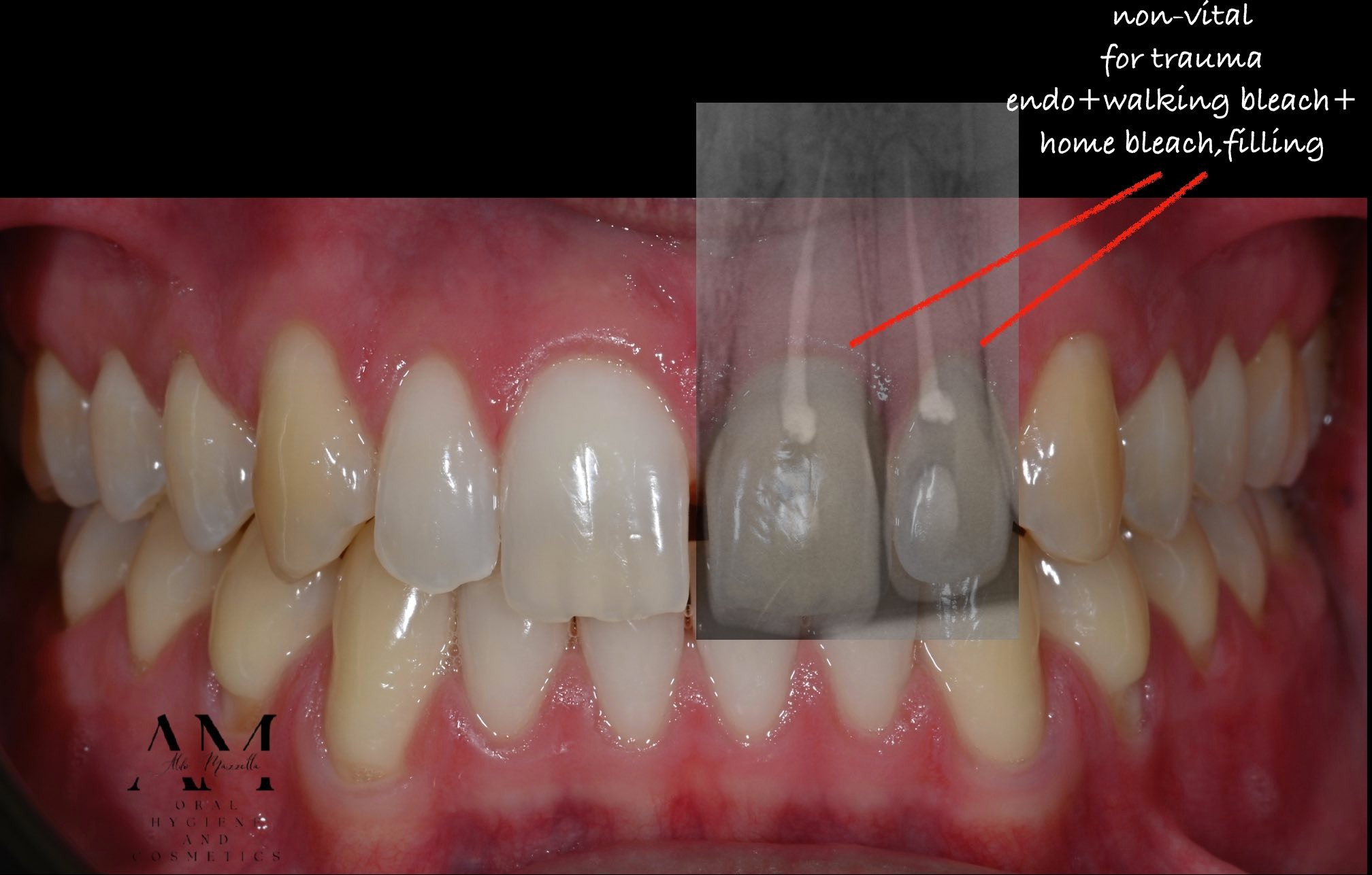 Radiographie endodontique — dent non vitale 2.1 et 2.2