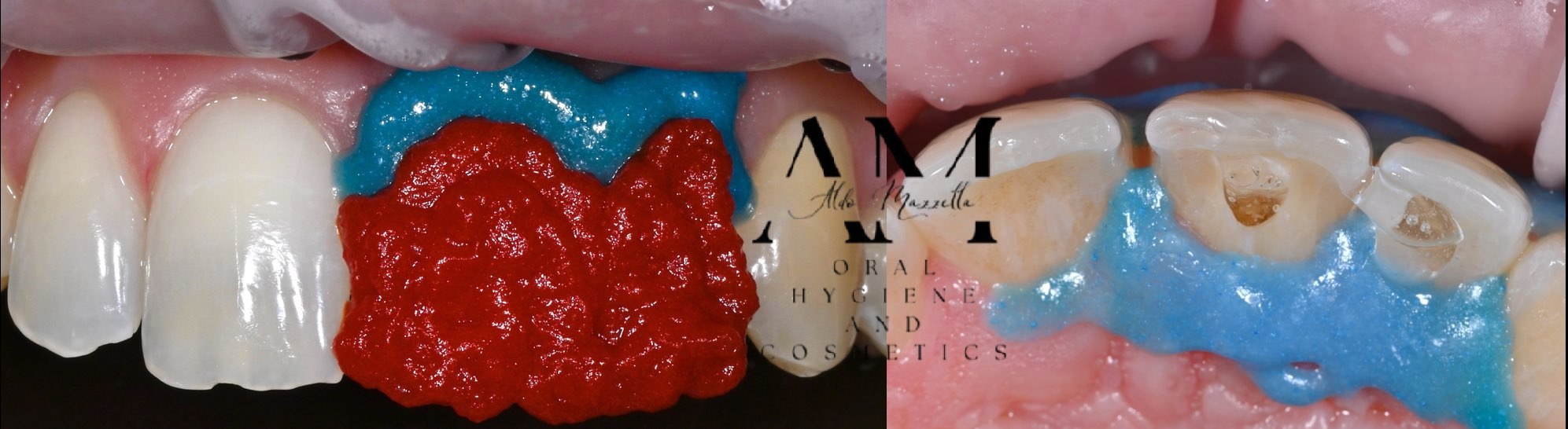 Application du gel BlancOne ULTRA 35% — protection gingivale