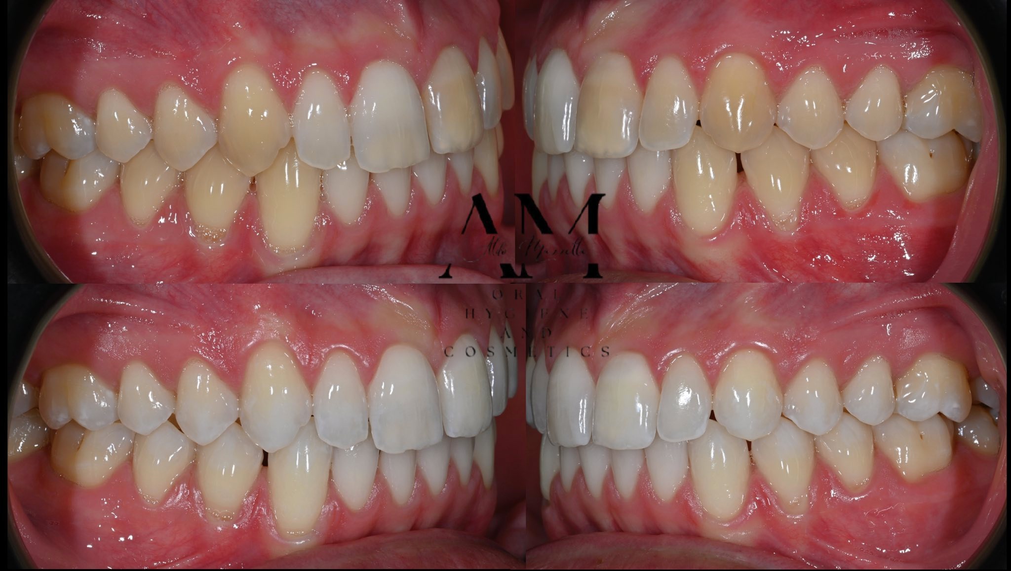 Vue quadrant — avant et après traitement