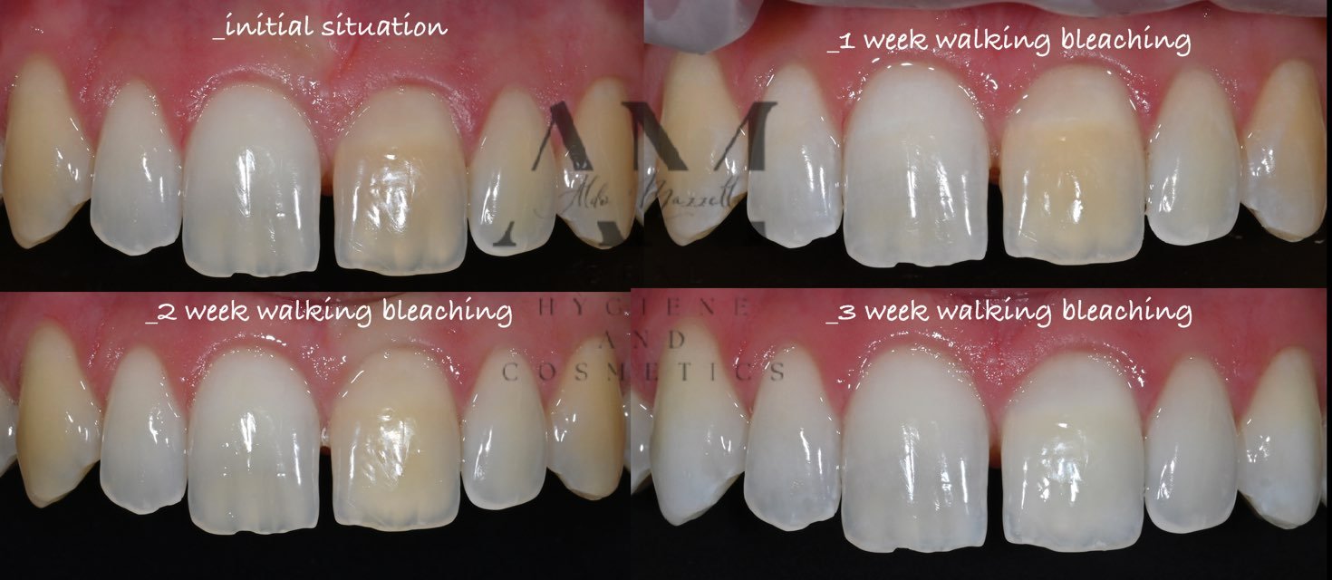 Suivi semaine par semaine — walking bleach