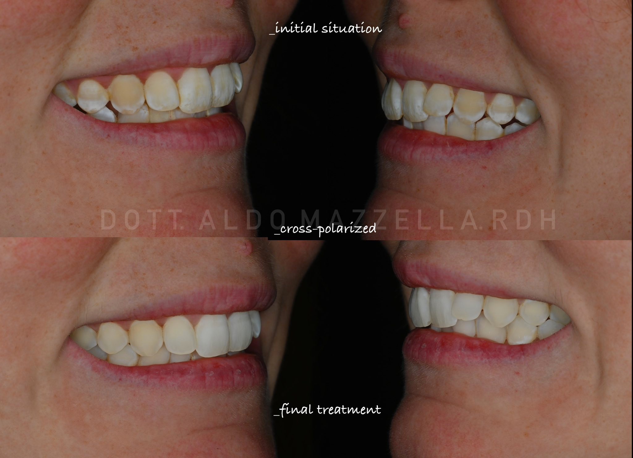 Avant / Après — sourire cross-polarisé