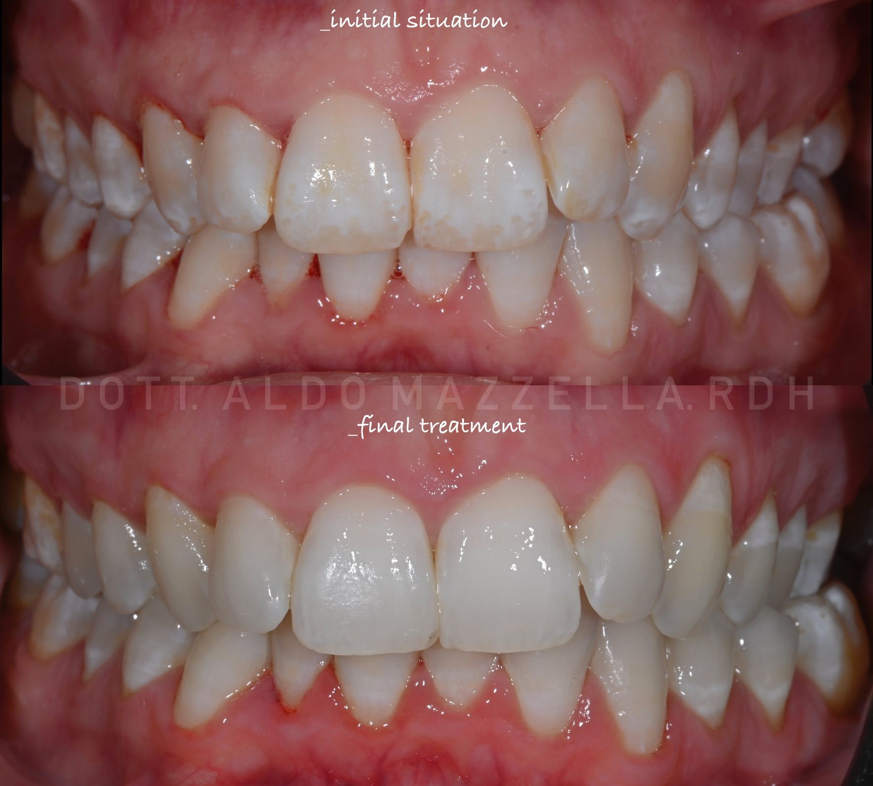 Avant / Après — vue frontale