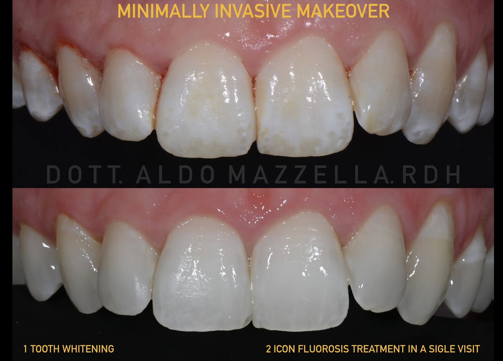 Minimally Invasive Makeover — incisives supérieures