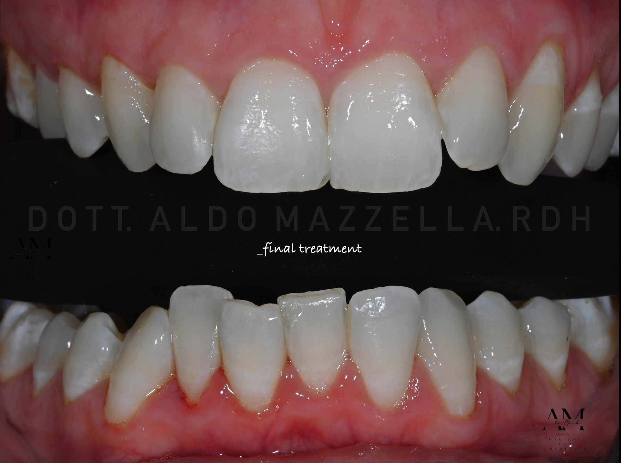 Minimally Invasive Makeover — incisives inférieures