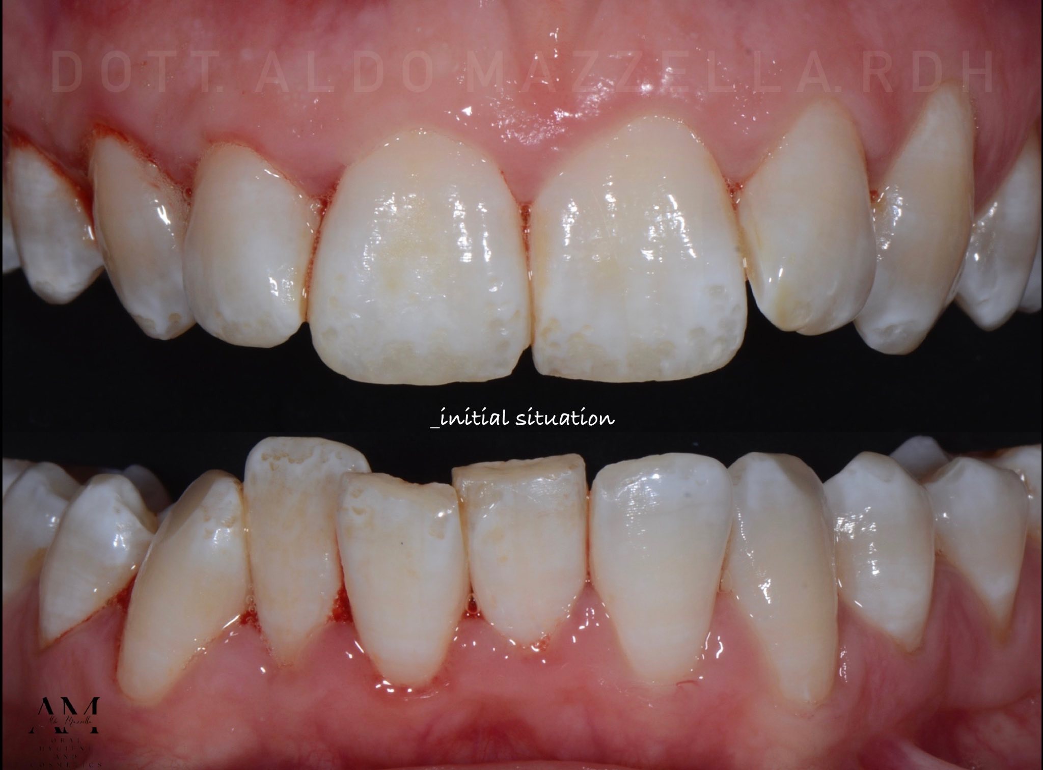 Avant / Après — sourire naturel