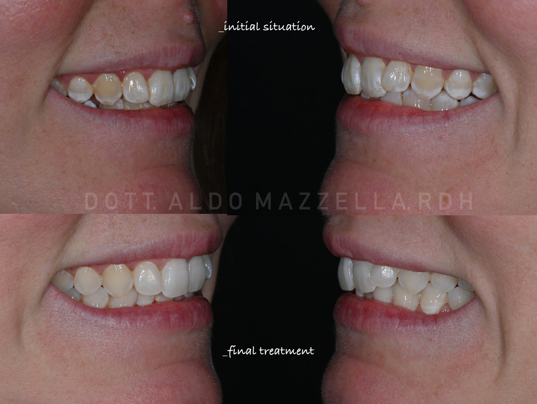 Avant / Après — vues latérales