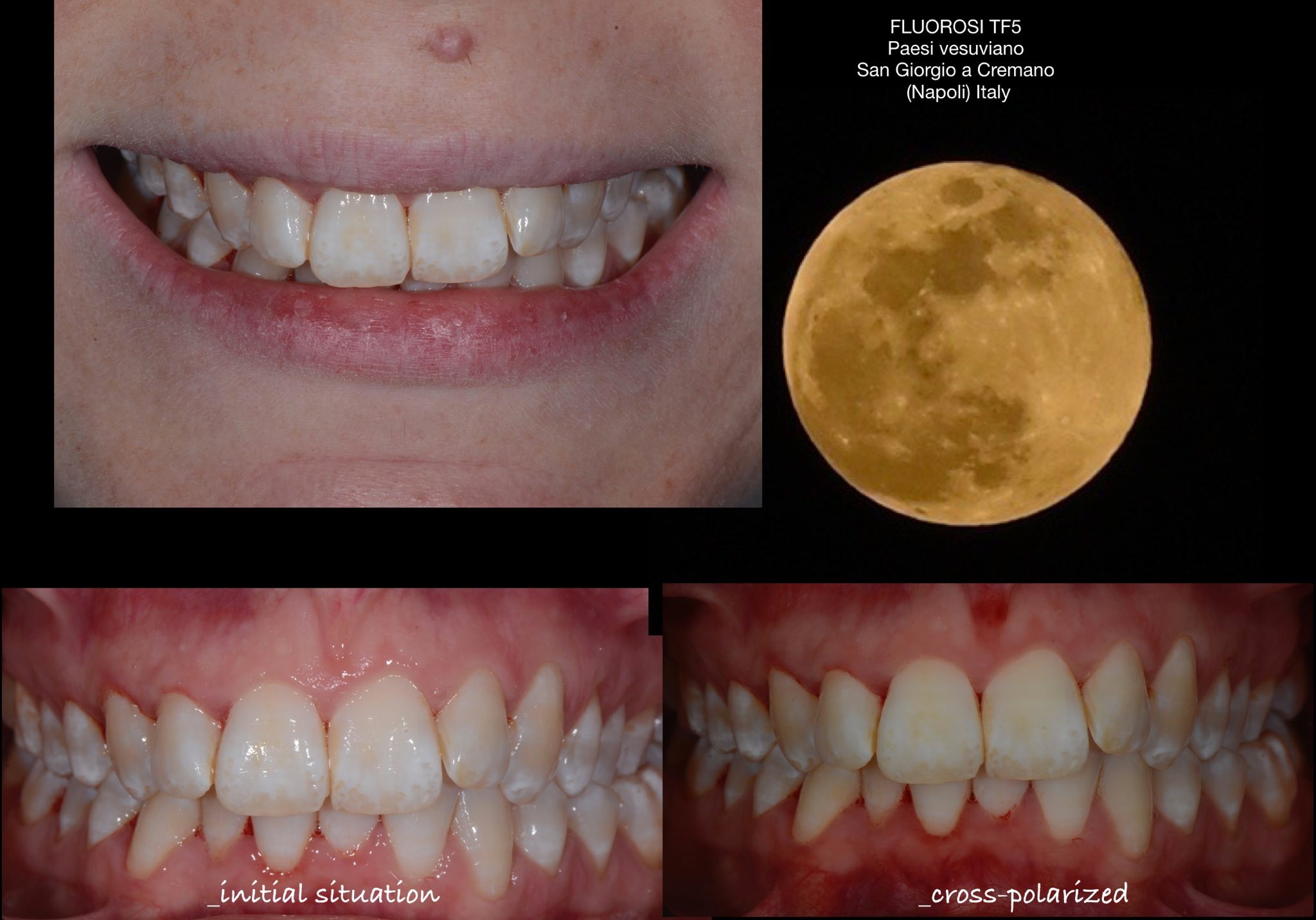 Situation initiale & cross-polarisée — vue du sourire