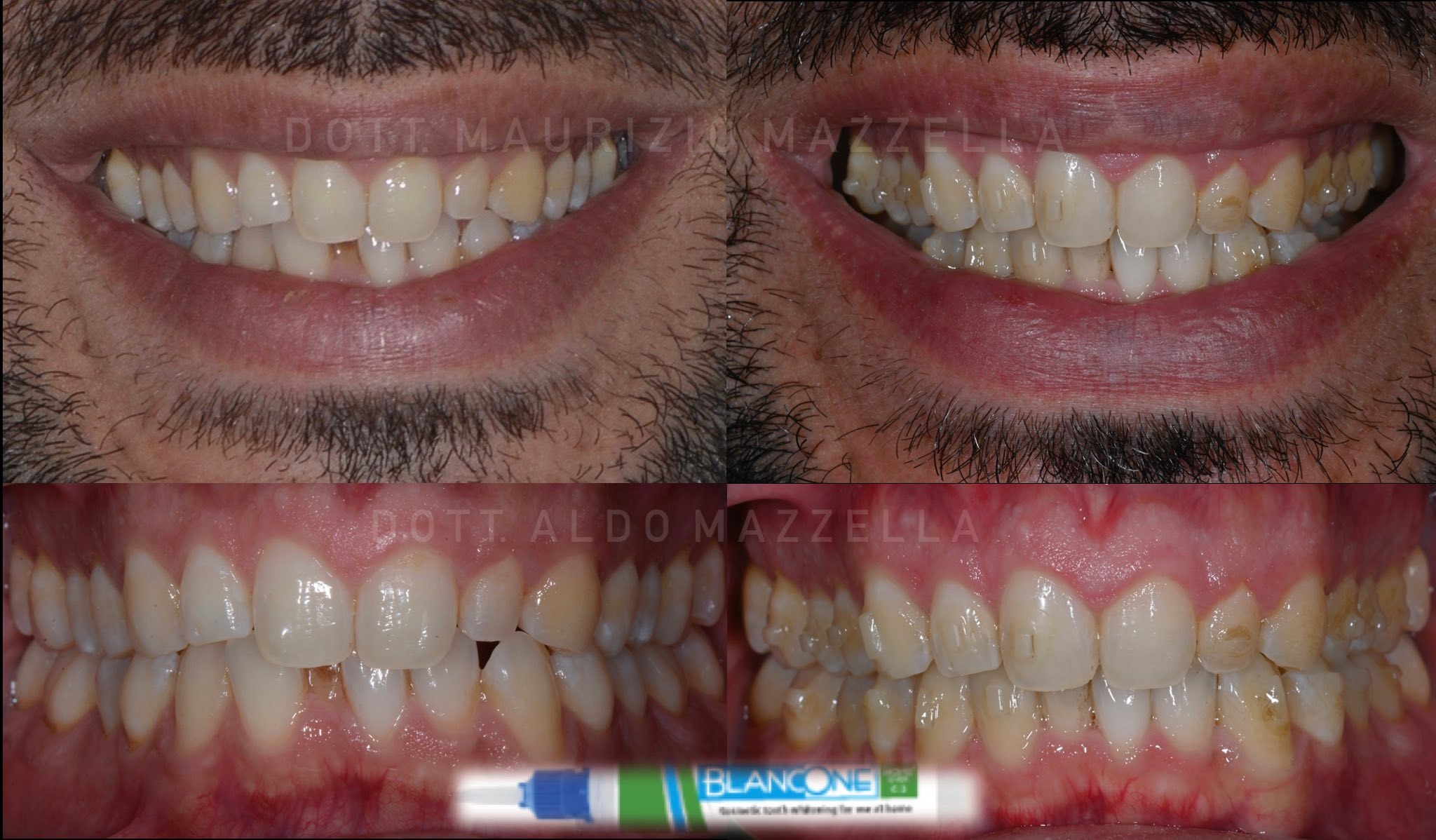 Avant / Après — Sourire & vues latérales