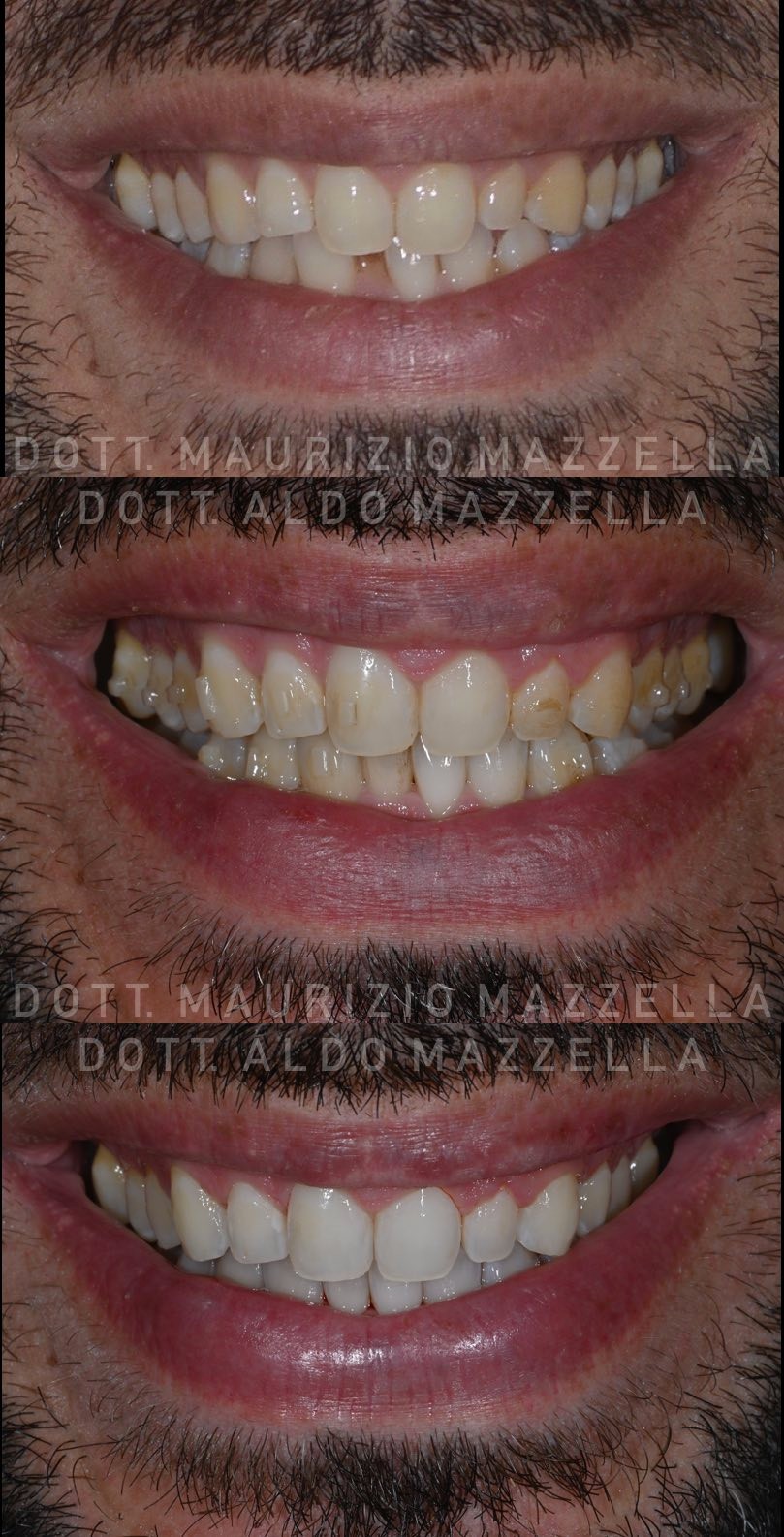 Avant / Après — Traitement combiné aligneurs + BlancOne Ever — Dr Aldo & Maurizio Mazzella