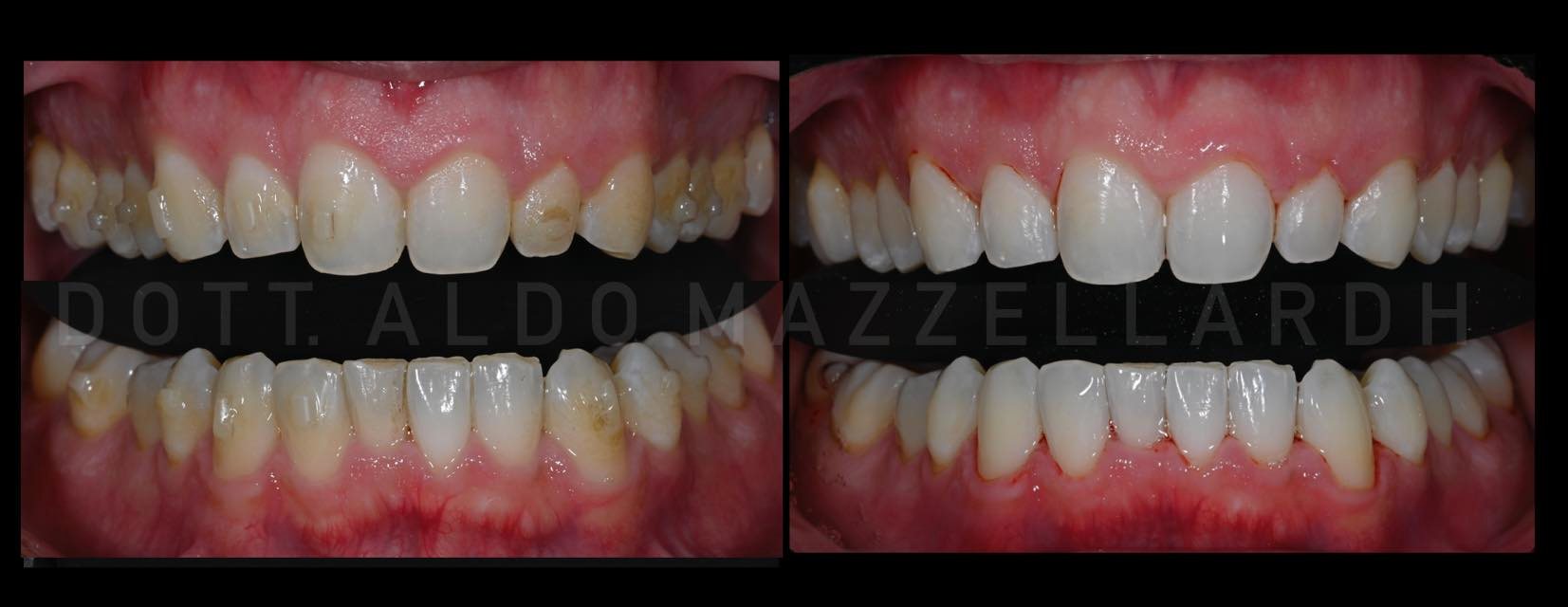 Avant / Après — Vue frontale intra-buccale