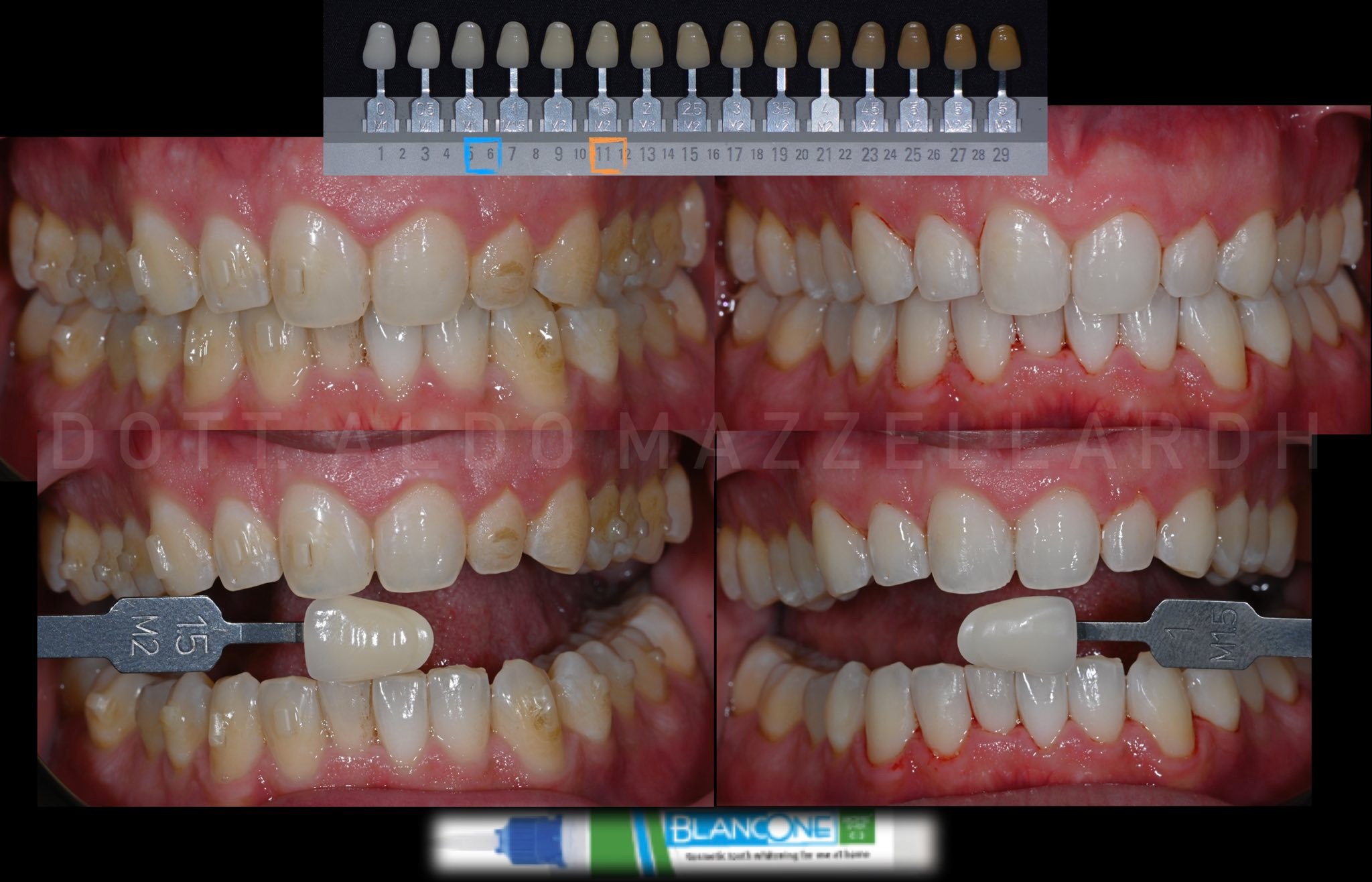 Mesure chromatique — Teinte 11 → 6 (Vita Bleach Guide)