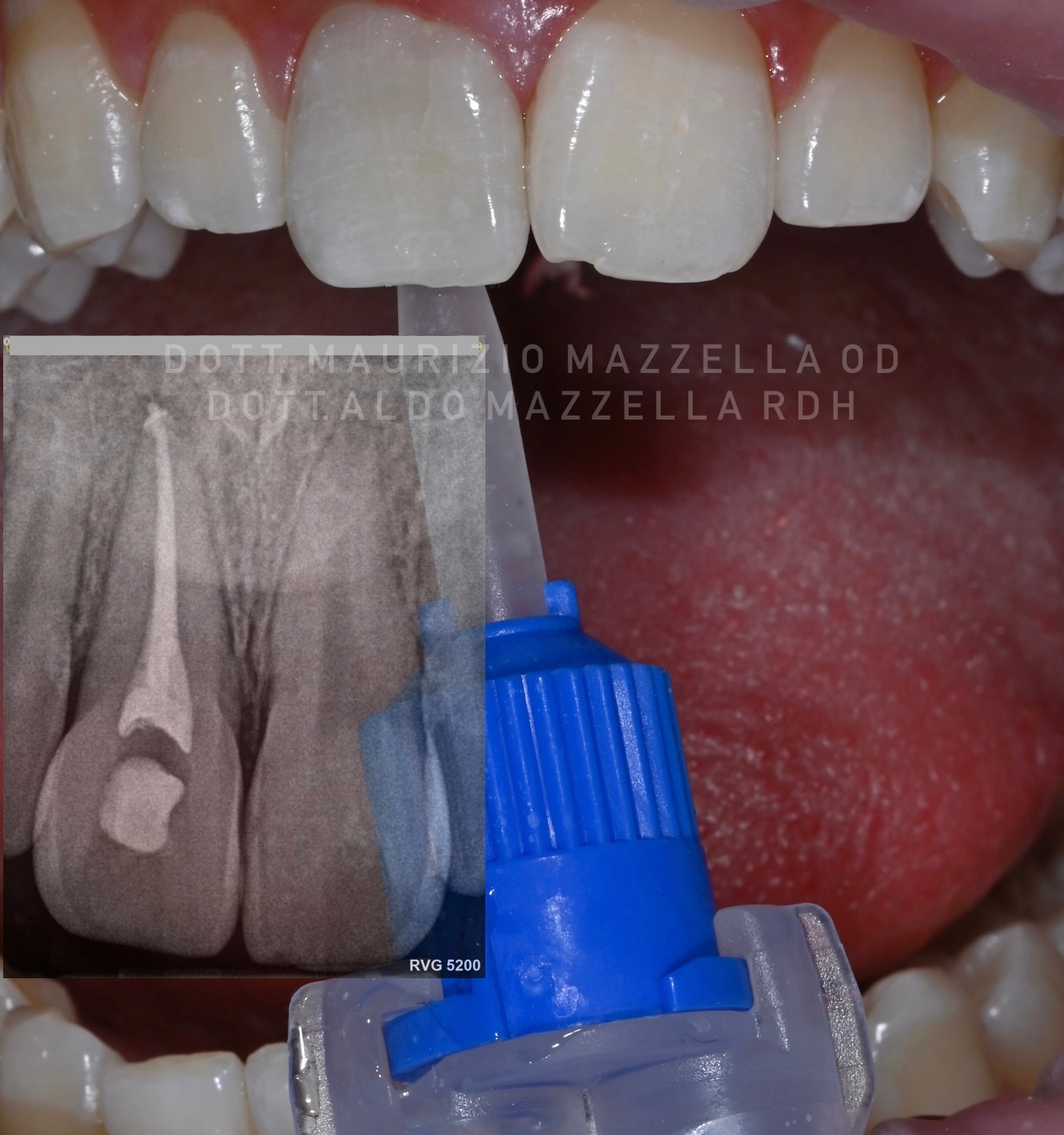 RVG 5200 — contrôle radiologique + application du gel BlancOne