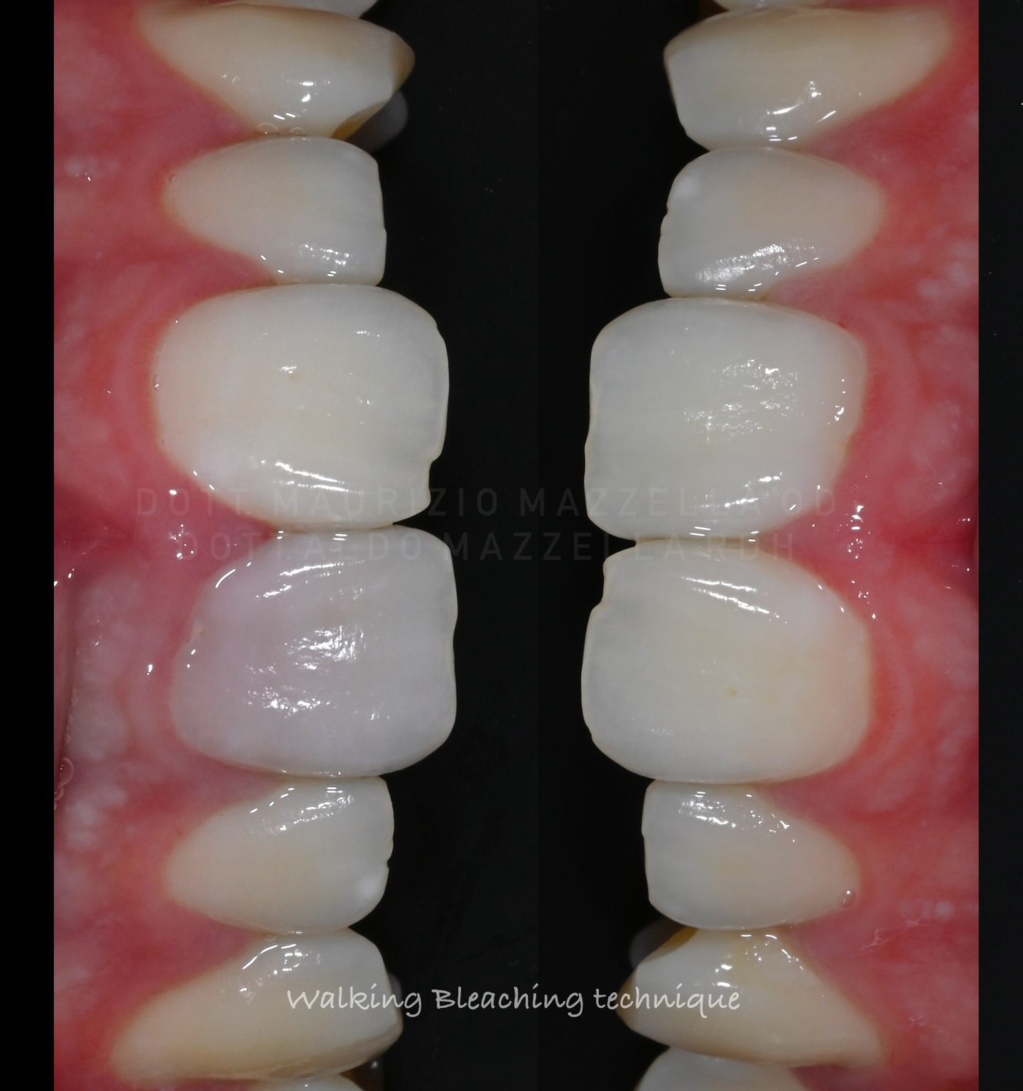 Vue occlusale — technique Walking Bleaching en cours