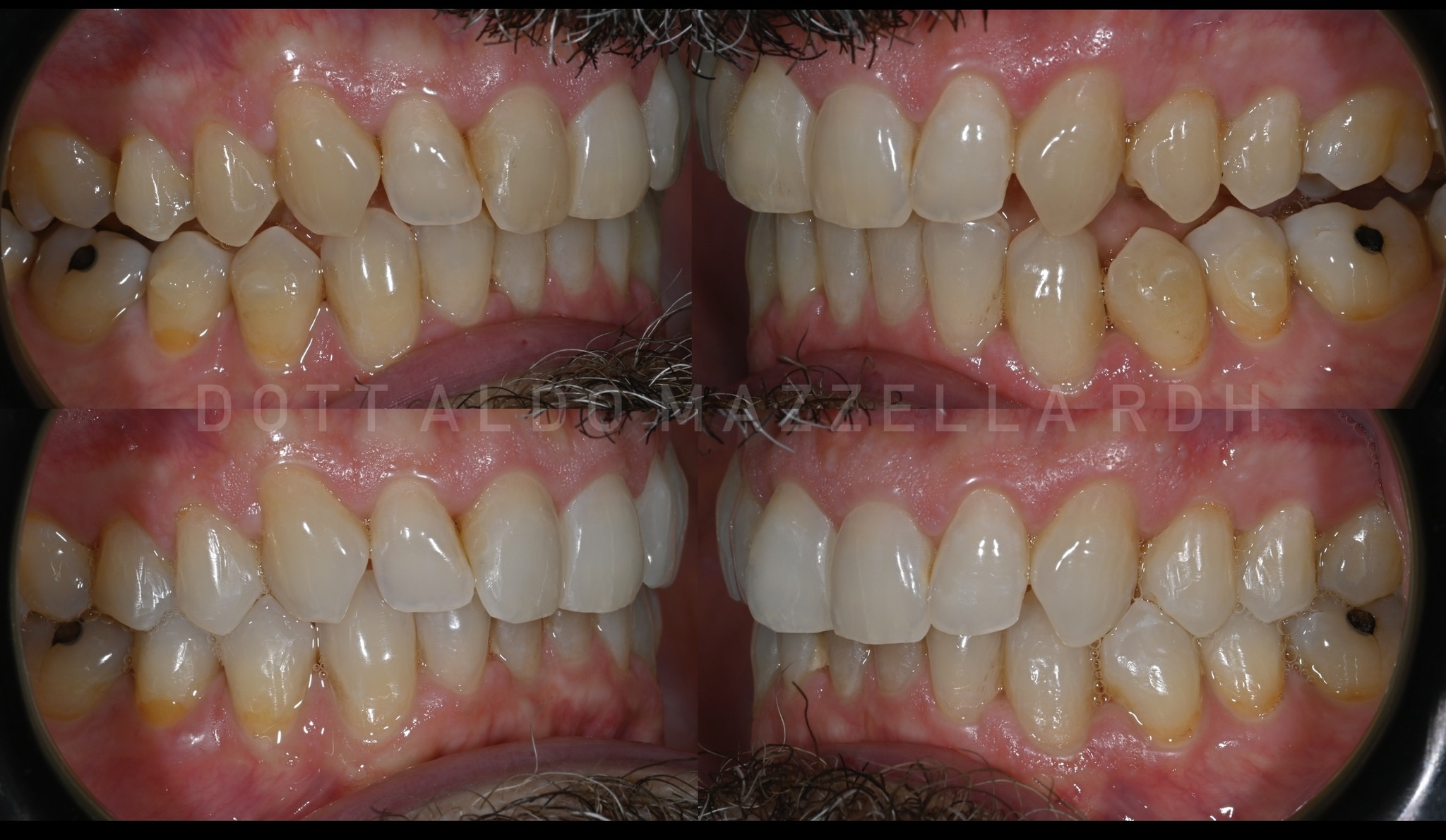 Vue latérale avant/après — arcade complète