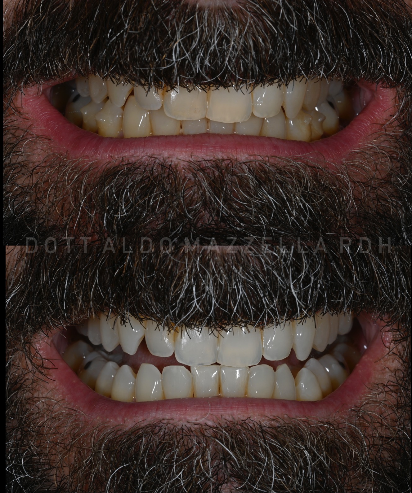 Avant / Après — résultat sourire complet