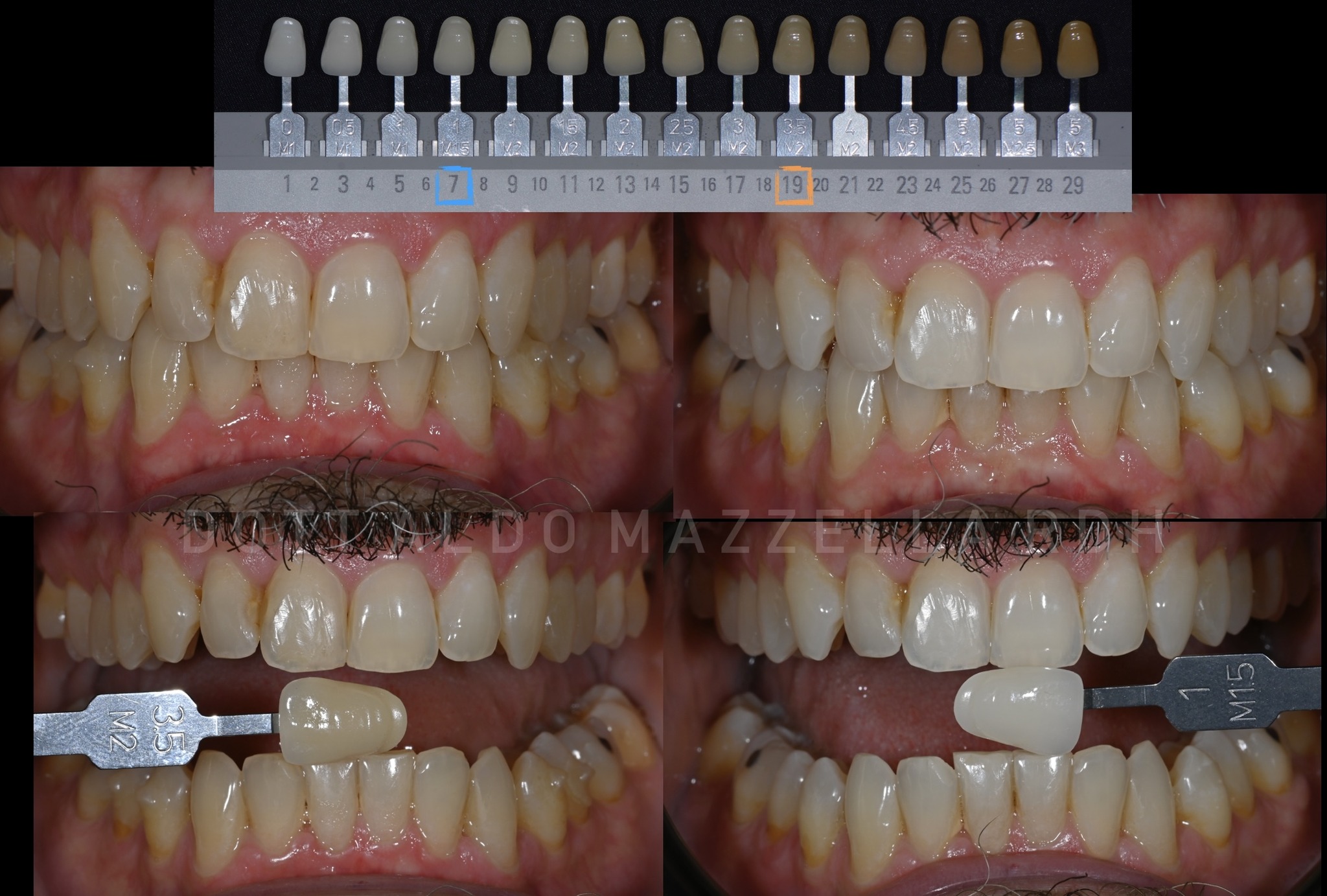 Progression chromatique — teinte 19 → teinte 7 (Vita Bleach Guide)