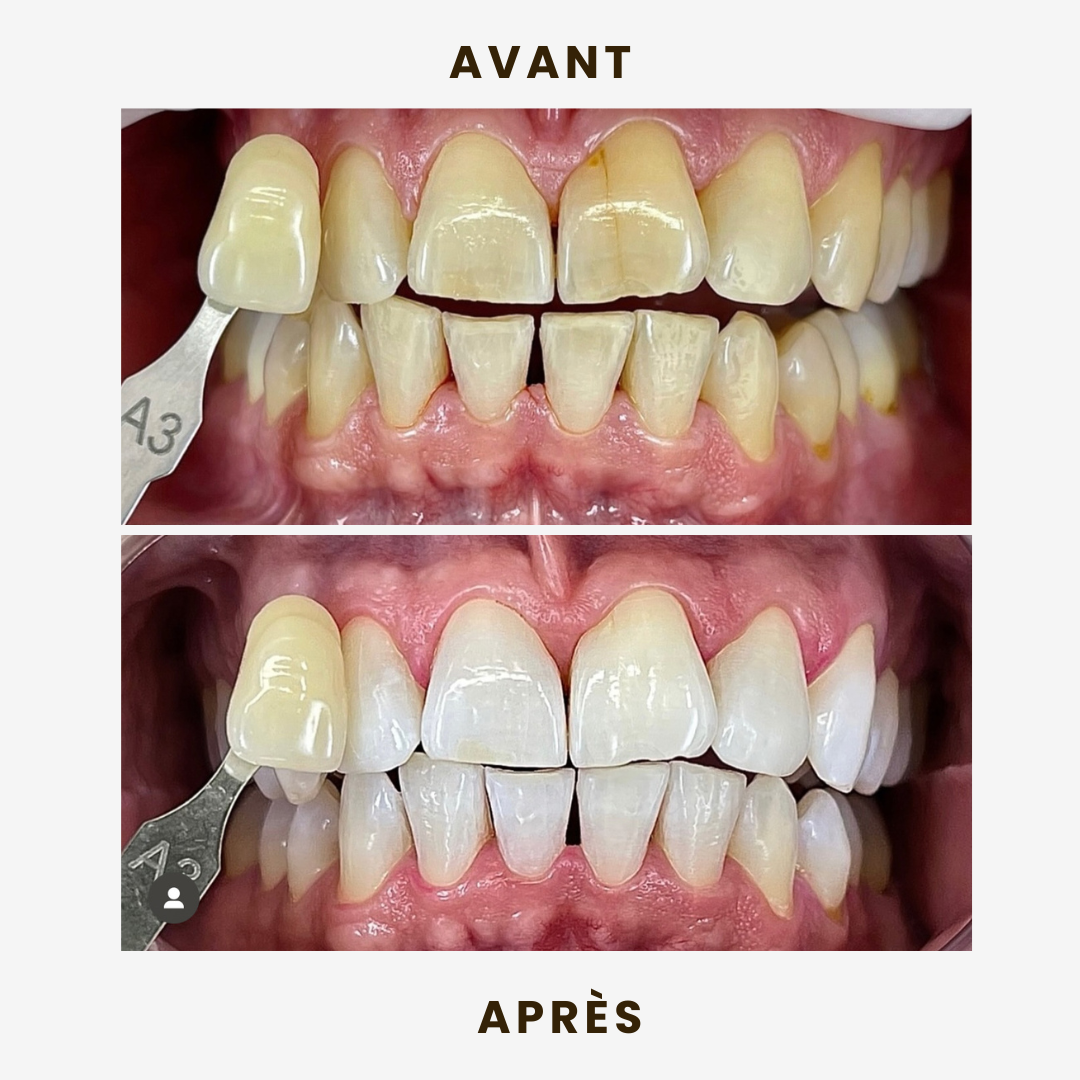 Dents jaunies par le café / thé