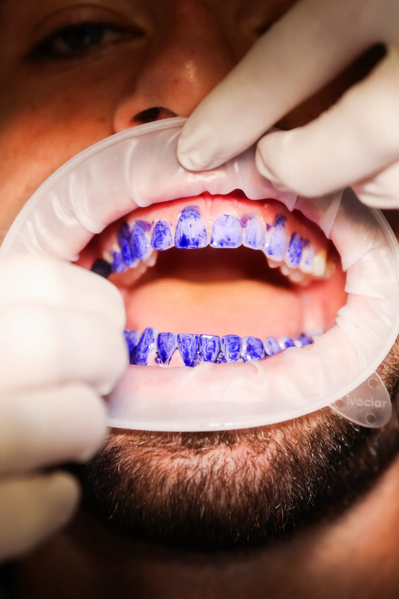 Soin BlancOne au fauteuil