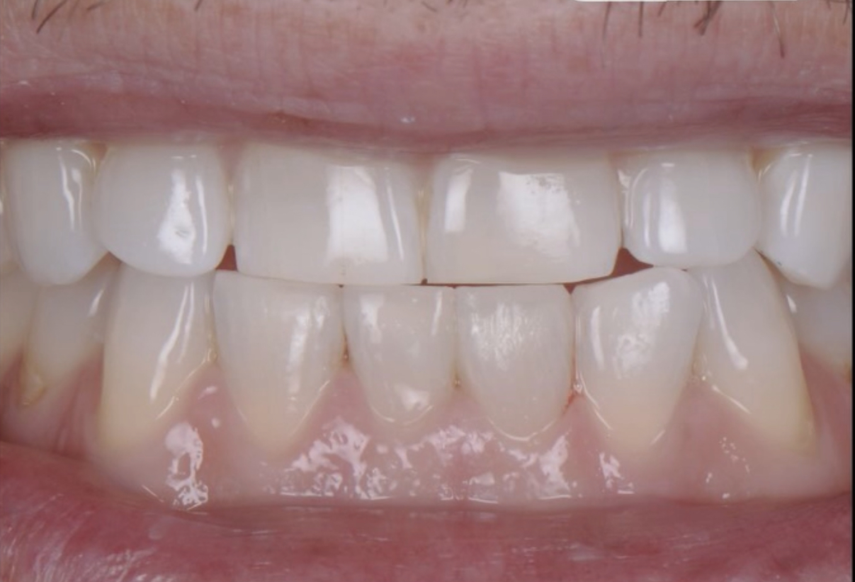 Avant — Vieillissement naturel du sourire