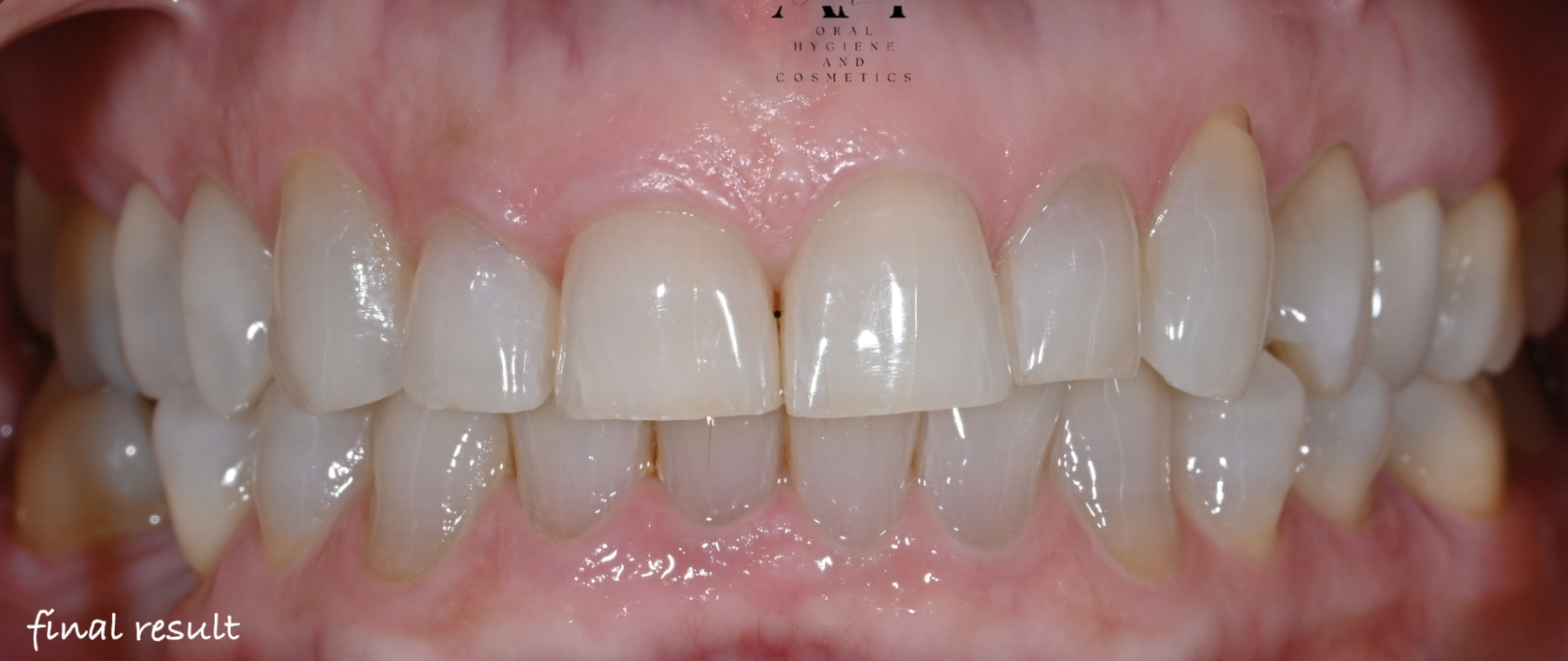 Avant — Colorations médicamenteuses (tétracyclines)