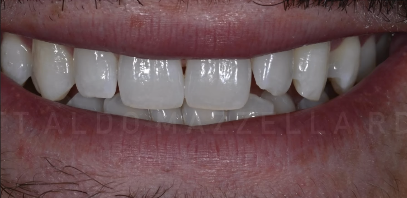 Avant — Sourire terne, manque d'éclat