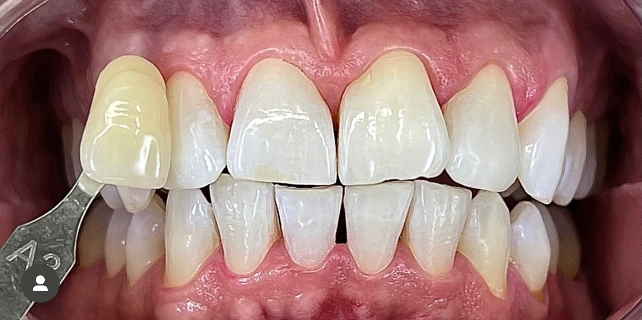 Avant — Tabac et colorations nicotiniques