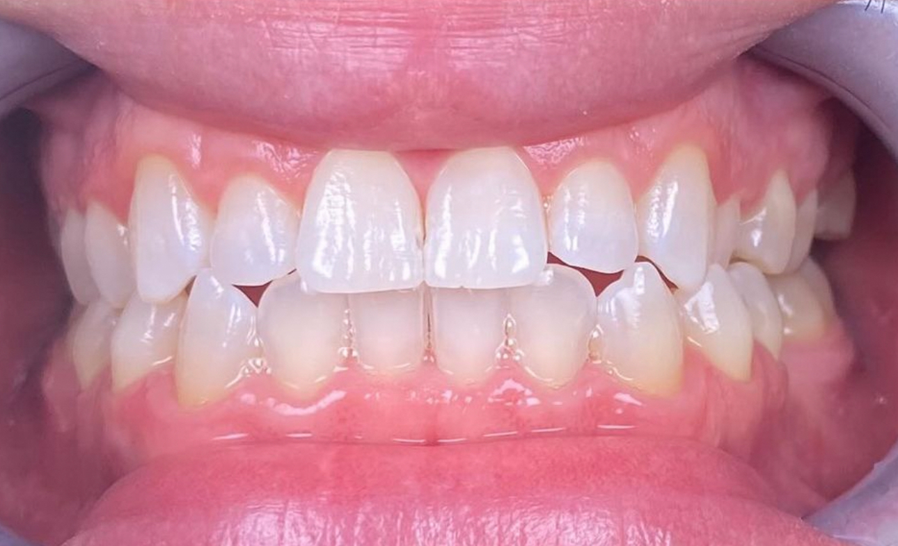 Contentions et suivi post-traitement — avant