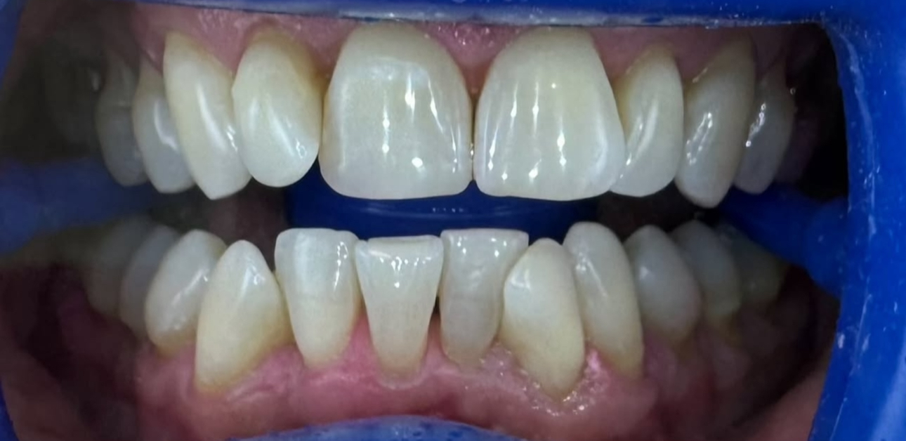 Avant — Tartre et plaque dentaire