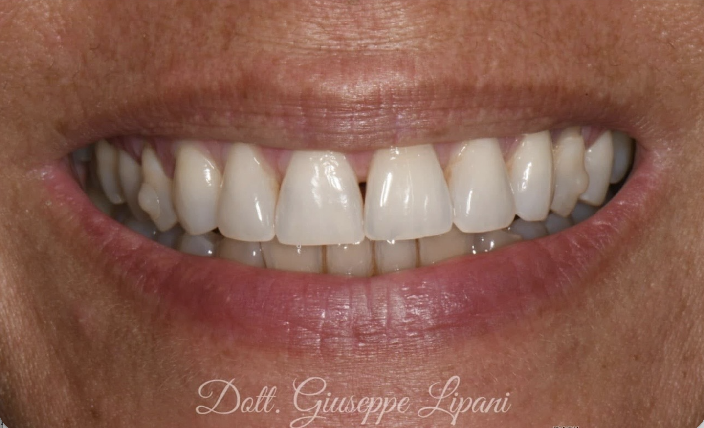 Orthodontie (avant, pendant, après) — avant