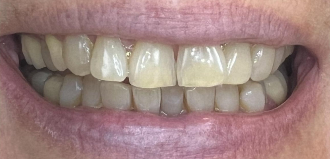 Après — Taches de café, thé, vin rouge