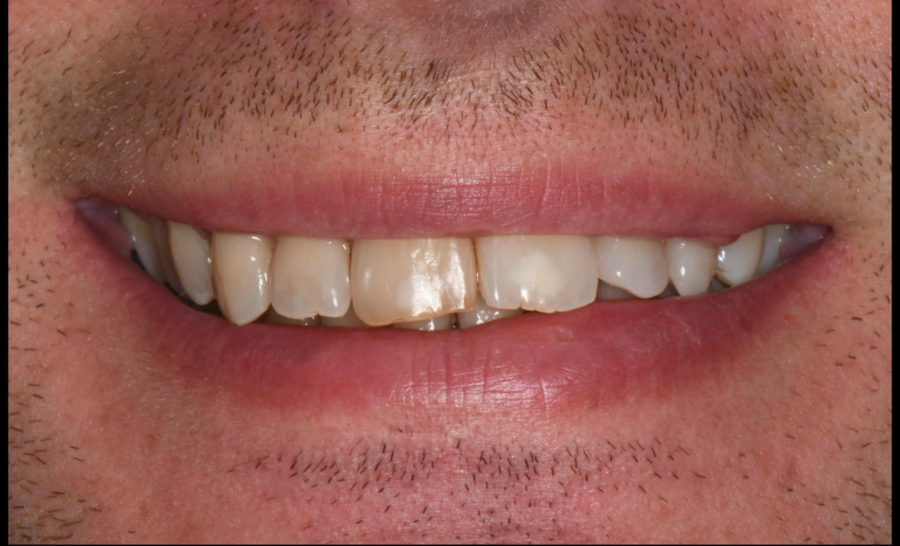 Dyschromies pathologiques — après