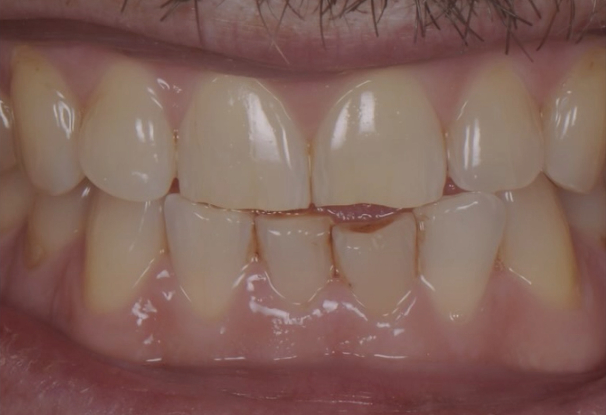 Plan de traitement restaurateur — après