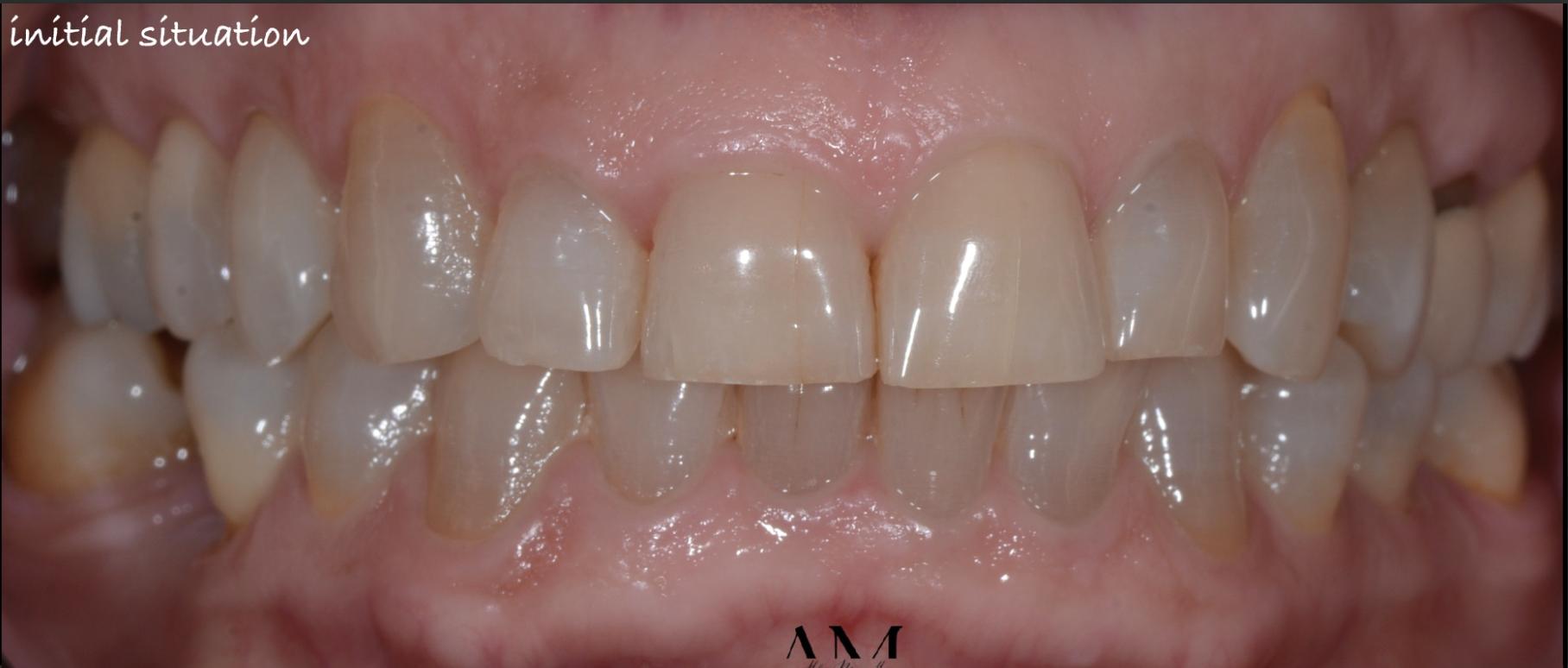 Après — Colorations médicamenteuses (tétracyclines)