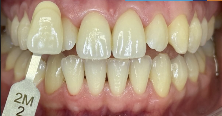 Vieillissement et colorations acquises — après