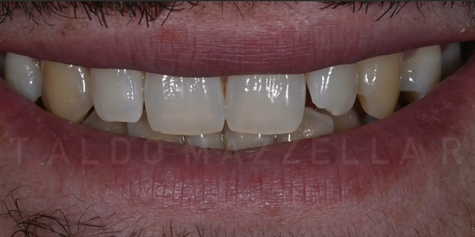 Après — Sourire terne, manque d'éclat