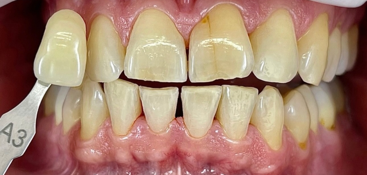 Après — Tabac et colorations nicotiniques