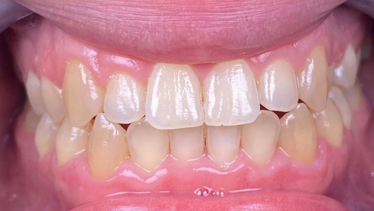 Contentions et suivi post-traitement — après