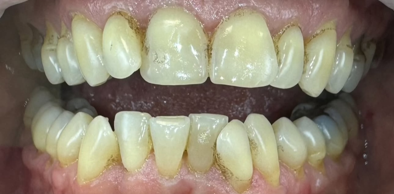 Après — Tartre et plaque dentaire