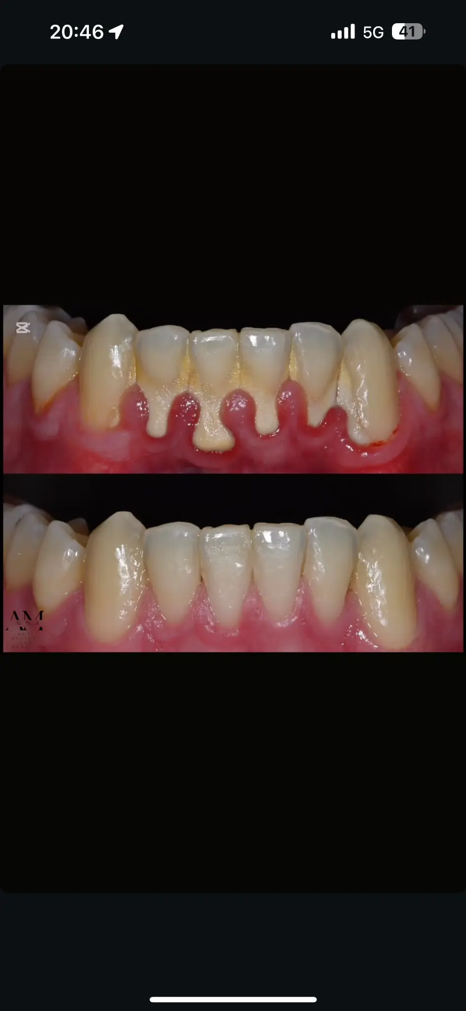 Avant/Après C&W Xpower — Prophylaxie