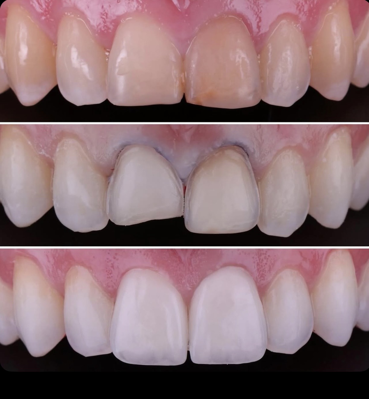 Séquence initial → try-in → résultat final — facettes feldspathiques — Dr Jean-David Boschatel